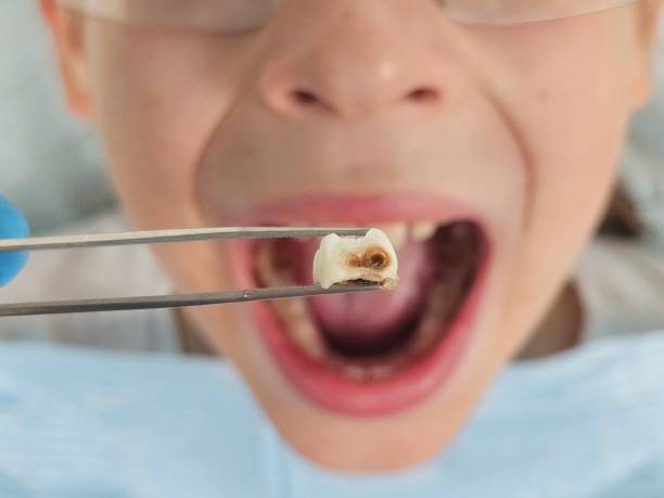Best Pediatric Emergency Dentist in Palm Valley, TX